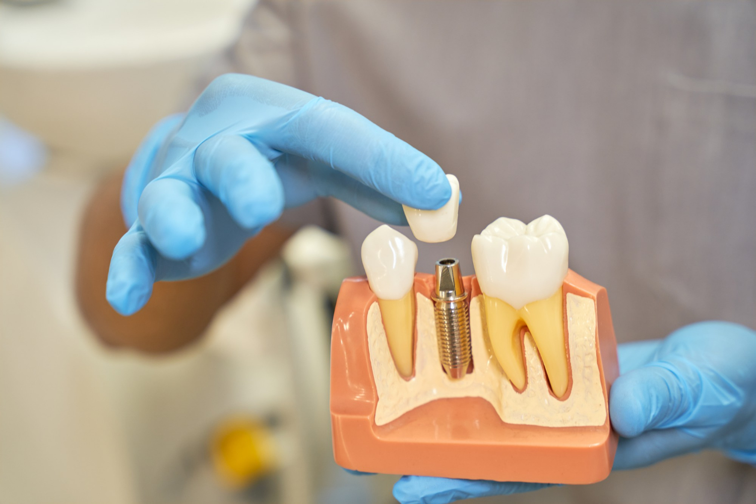 Implantes Dentários: Como Escolher o Melhor Tipo para Você