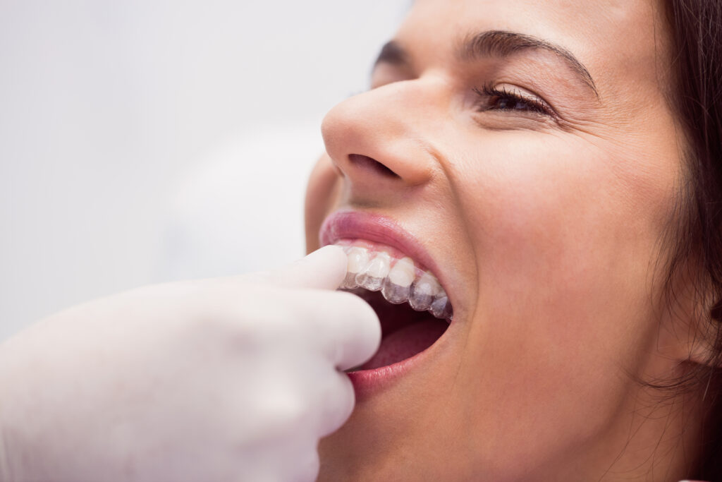 Facetas em Porcelana vs. Lentes de Contato Dental: Qual escolher?