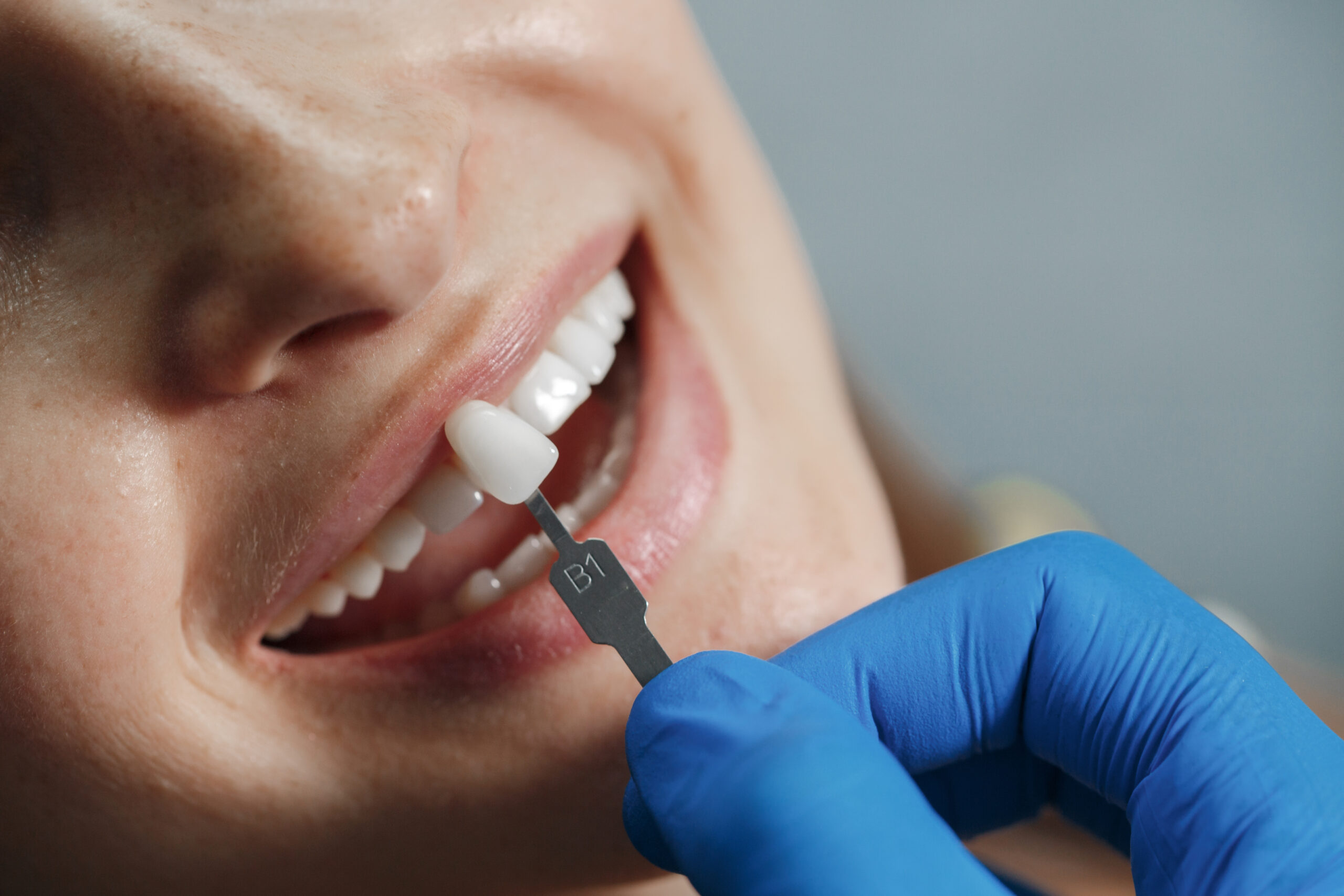 Clareamento Dental: Os Benefícios para Além do Sorriso